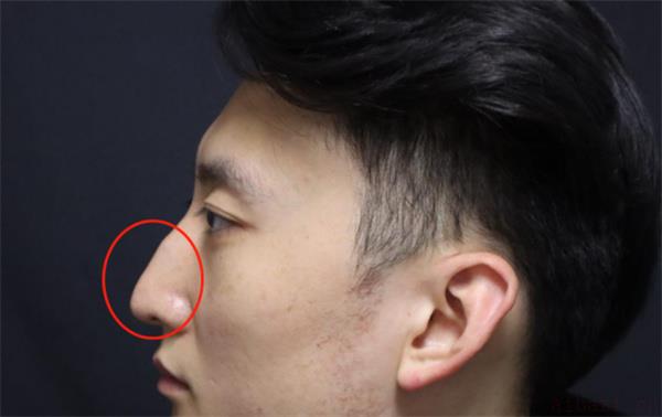 探讨从鼻梁看健康好坏的方法 如何从鼻梁看你的健康好坏